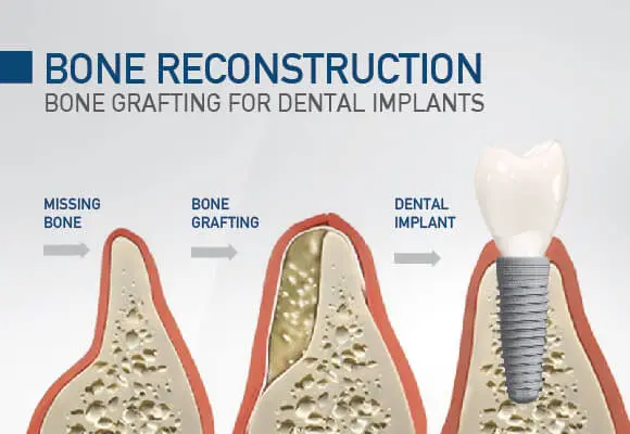 Bone grafting for dental implants Vancouver Burnaby BC