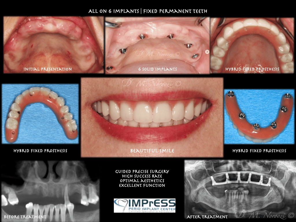 All on 4 All on 6 implants Teeth in a day Full Implant Denture IMPrESS Perio Implant Center Dr. Noroozi Vancouver Implant Specialist