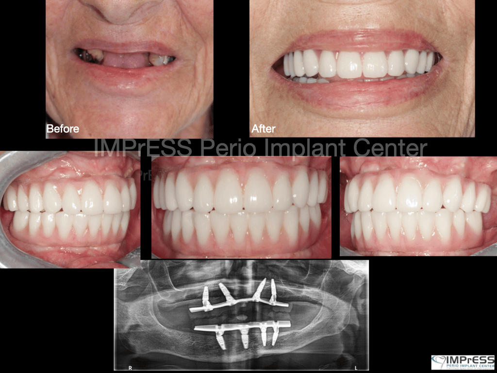 All on Four Implants Vancouver Burnaby BC Teeth in a day IMPrESS Perio Implant Center Dr. Noroozi