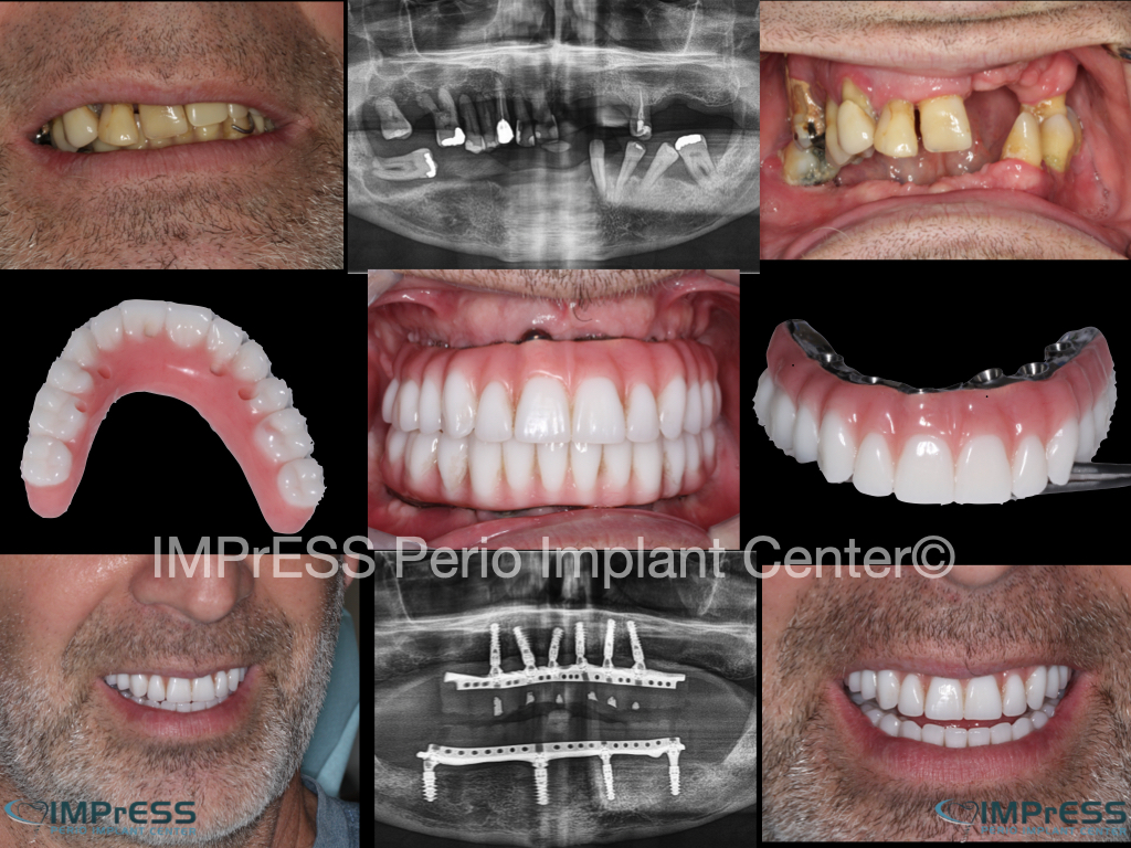 All on X Full Mouth Implant Rehabilitation IMPrESS Perio Implant Center Dr. Noroozi Implant Specialist Burnaby