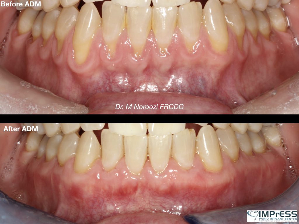 Best Gum Graft Alternative with Dermal graft to treat gum recession Dr. Noroozi Vancouver Periodontist IMPrESS Perio Implant