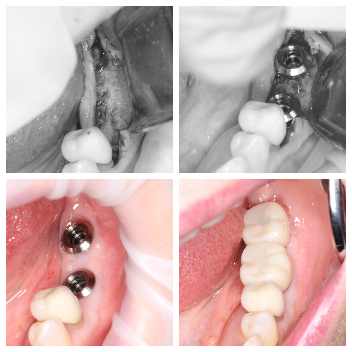Bone Graft Implants Dr Noroozi IMPRESS Perio Implant Center