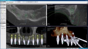 Computer Guided Implant Surgery Vancouver Burnaby Dental Implant Specialist Dr.Noroozi