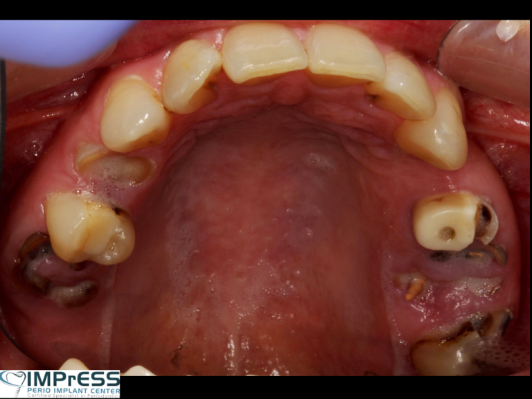 Aesthetic Crown Lengthening for Gummy Smile or Uneven Gum Line