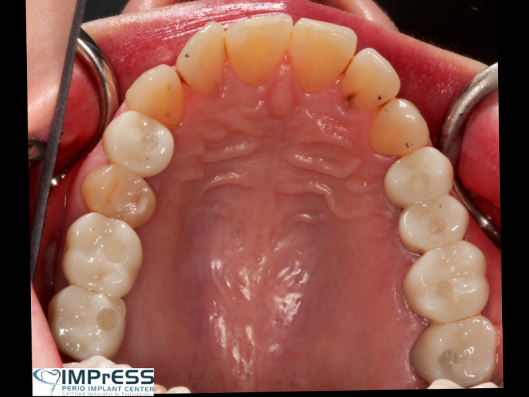 Dental Implants Vancouver BC