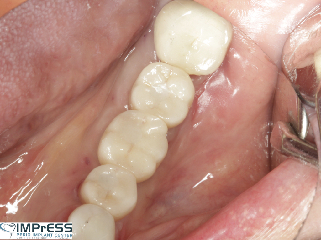 Dr. Noroozi IMPrESS Perio Implant Center Vancouver and Burnaby Advanced Centre for Periodontics and Implant Dentistry