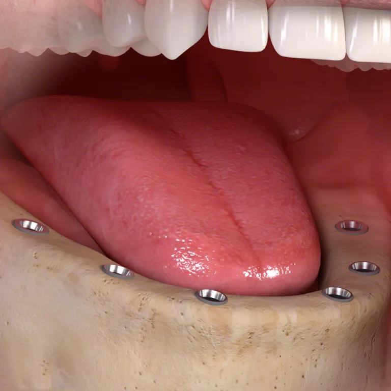 Fixed Implant Denture Burnaby BC IMPrESS Perio Implant Center