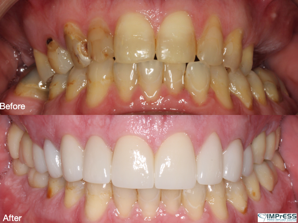 Full Mouth Reconstruction In Burnaby Prosthodontist Periodontist IMPrESS Perio Implant Center.001