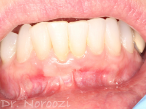 Gum Graft Surgery Gum Grafting for Treatment of Receding Gums Frenectomy Dr. Noroozi Gum Graft Specialist Periodontist IMPrESS Perio Implant Center