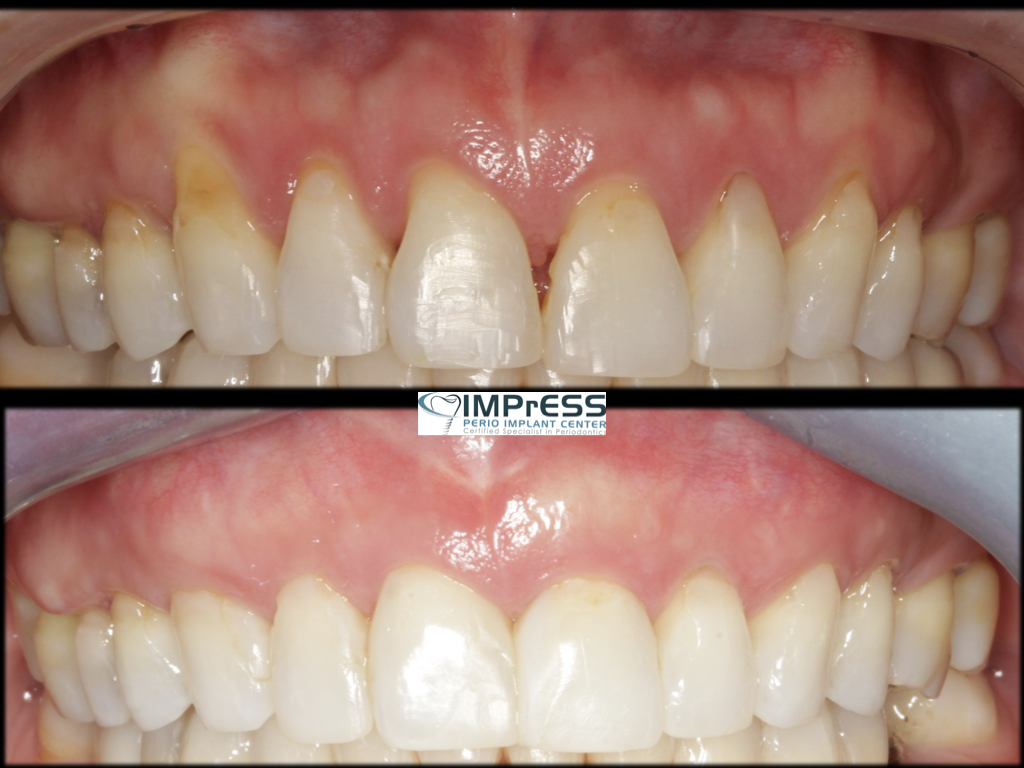 Gum Grafting for Gurm Recession Treatment IMPrESS Perio