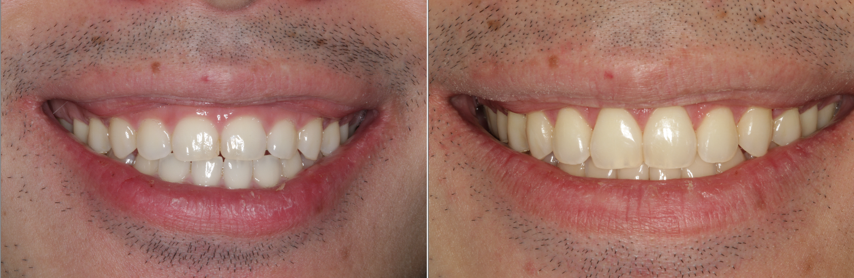 Gummy Smile Treatment Esthetic Crown lengthening Dr. Noroozi IMPrESS Perio Implant Center Burnaby BC Vancouver Burnaby Periodontist