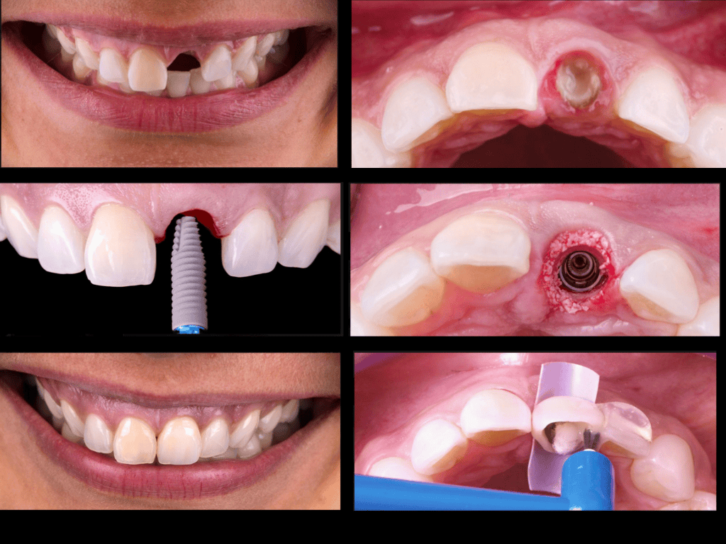 Immediate Implant and Crown, Same-day implant teeth Vancouver Burnaby BC