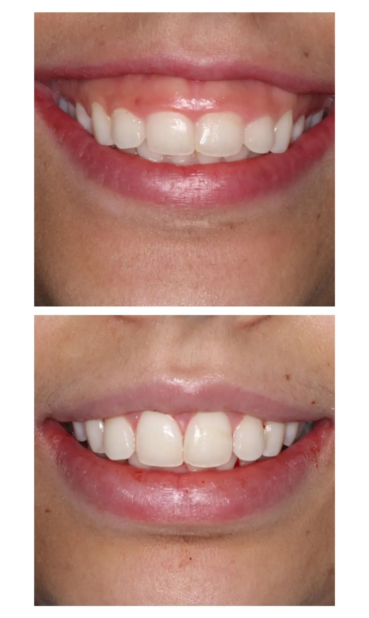 Lip Repositioning and Esthetic Crown Lengthening Surgery IMPrESS Perio Implant Center Burnaby