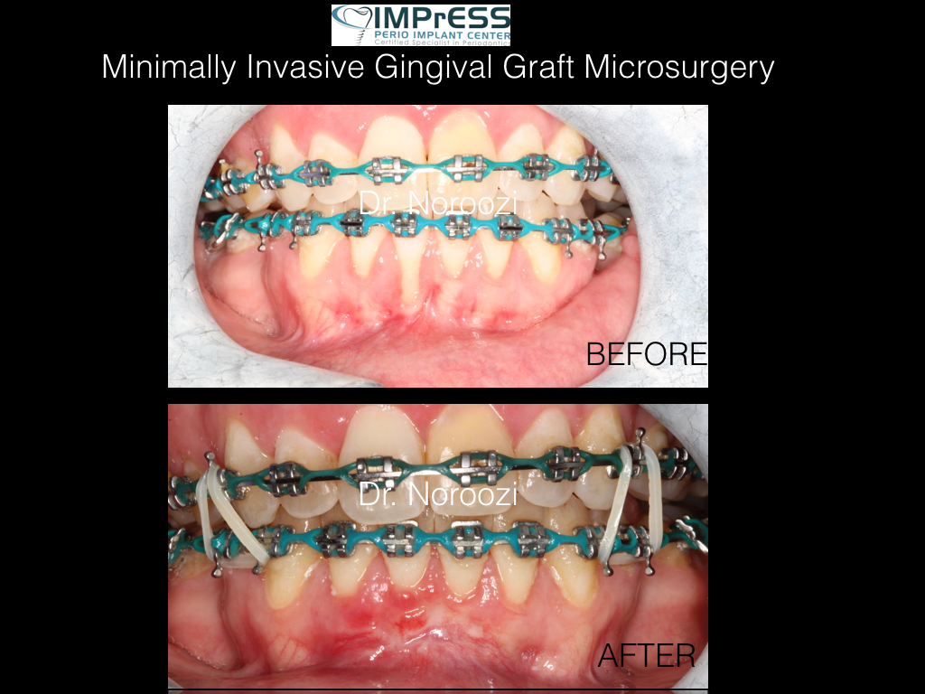 Gum recession after braces best Gum graft specialist in Vancouver bc IMPrESS Perio