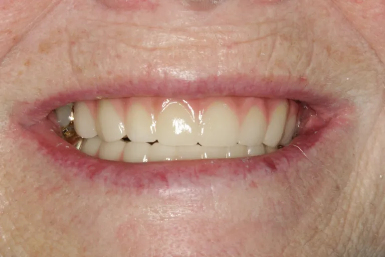Fixed Implant Teeth IMPrESS Perio Implant Center Dr. Noroozi Implant Specialist