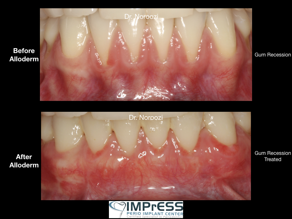 Pinhole Surgical Technique Alloderm Gum Recession Treatment Vancouver BC