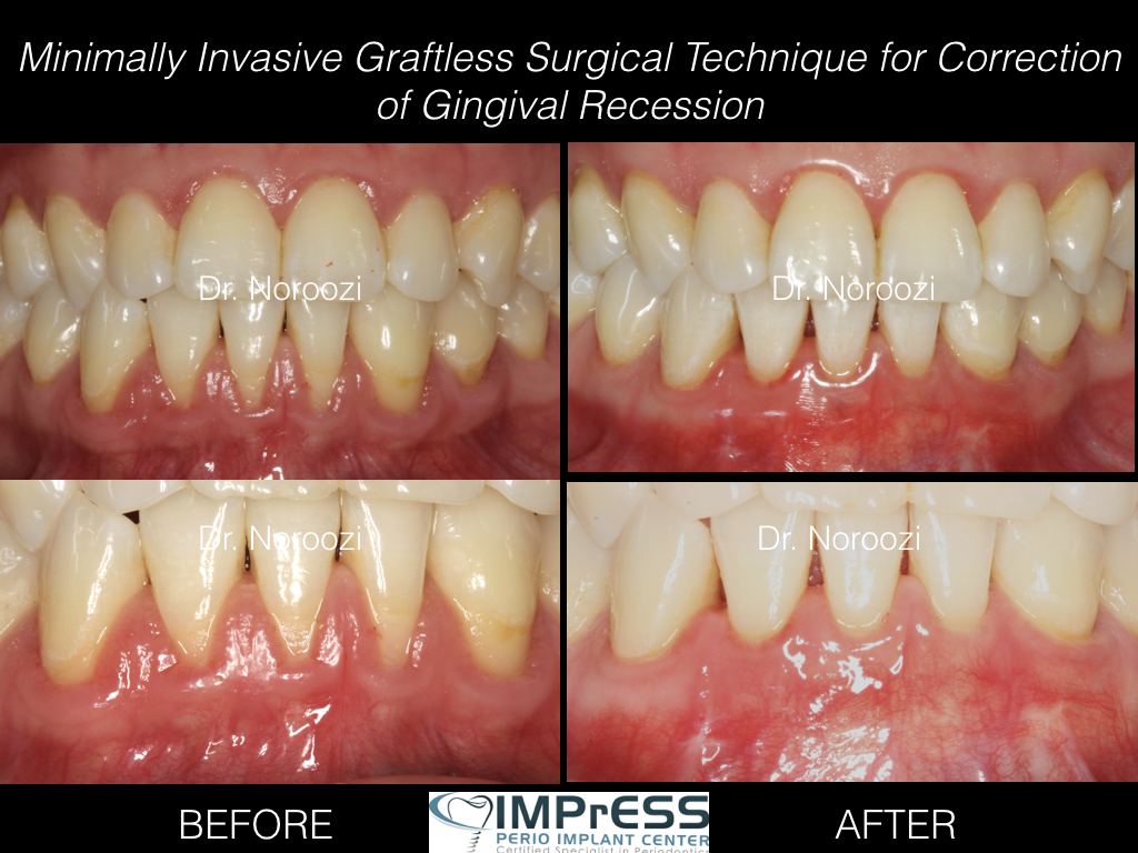 Pinhole Surgical Technique Gum Graft Alternative for treatment of Gum recession IMPrESS Perio Dr. Noroozi