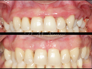 Pocket Reduction Surgery Open Flap Debridement Laser Gum Surgery Dr. Noroozi Periodontist Vancouver Burnaby BC