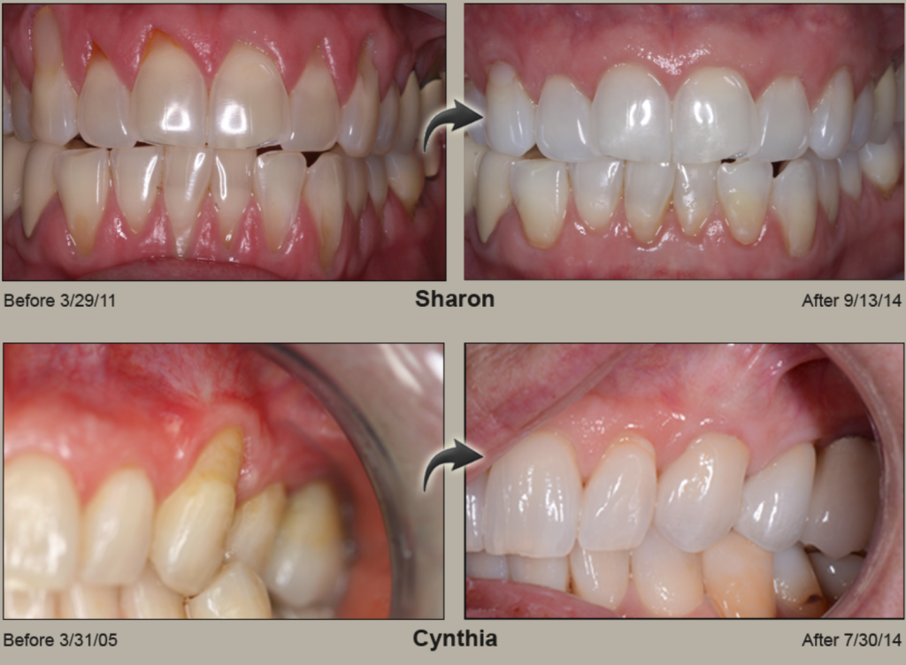 Pinhole Gum Rejuvenation Dr. Mehdi Noroozi Burnaby Periodontist IMPrESS Perio Implant Center
