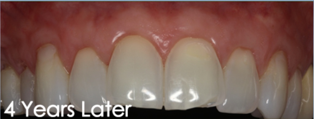 Pinhole Gum Rejuvenation Dr. Mehdi Noroozi Burnaby Periodontist