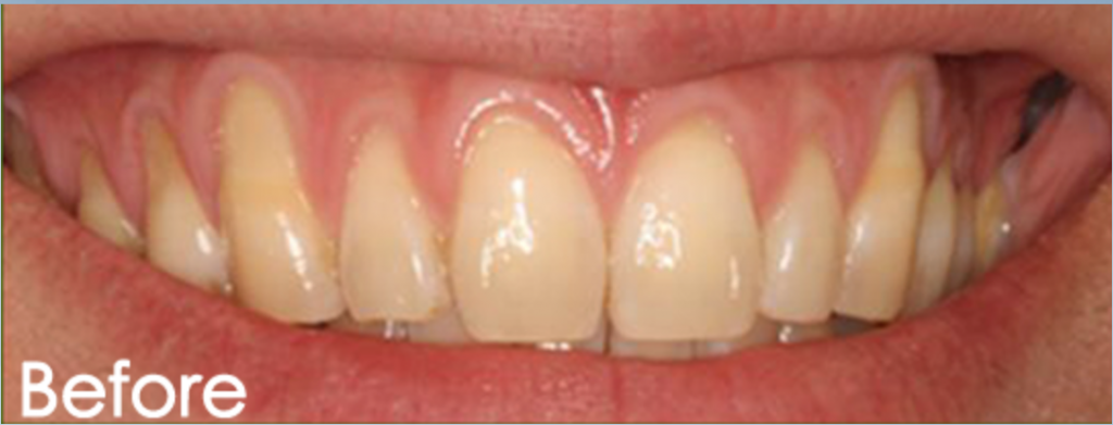 Pinhole Surgery Gum Rejuvenation Dr. Mehdi Noroozi Burnaby BC Periodontist