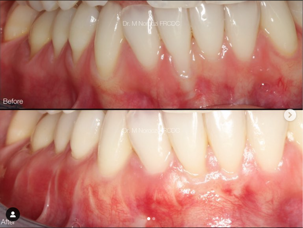 What is Pinhole Surgical Technique™ in Vancouver BC?