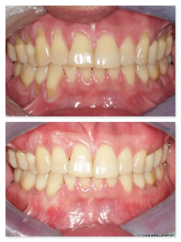 Severe Gum Recession Treatment Gum Grafting Dr. Noroozi IMPrESS Perio Implant Center Vancouver Burnaby Periodontist