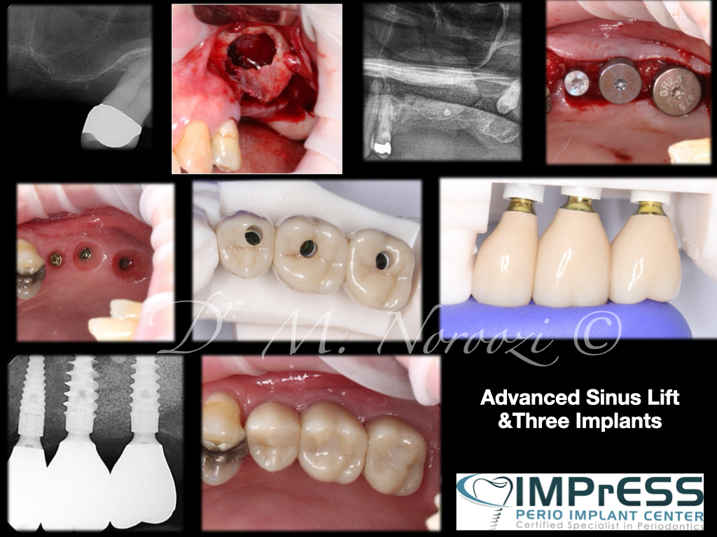 Sinus Lift, Bone Graft, Implants Dr. Noroozi IMPrESS Perio Implant Center