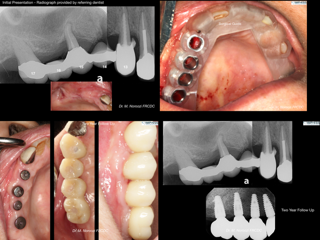 Sinus Lift Guided Dental Implant Surgery Vancouver BC Dr. Noroozi Periodontist in Burnaby BC