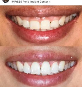 Crown Lengthening Gummy Smile Treatment Vancouver BC