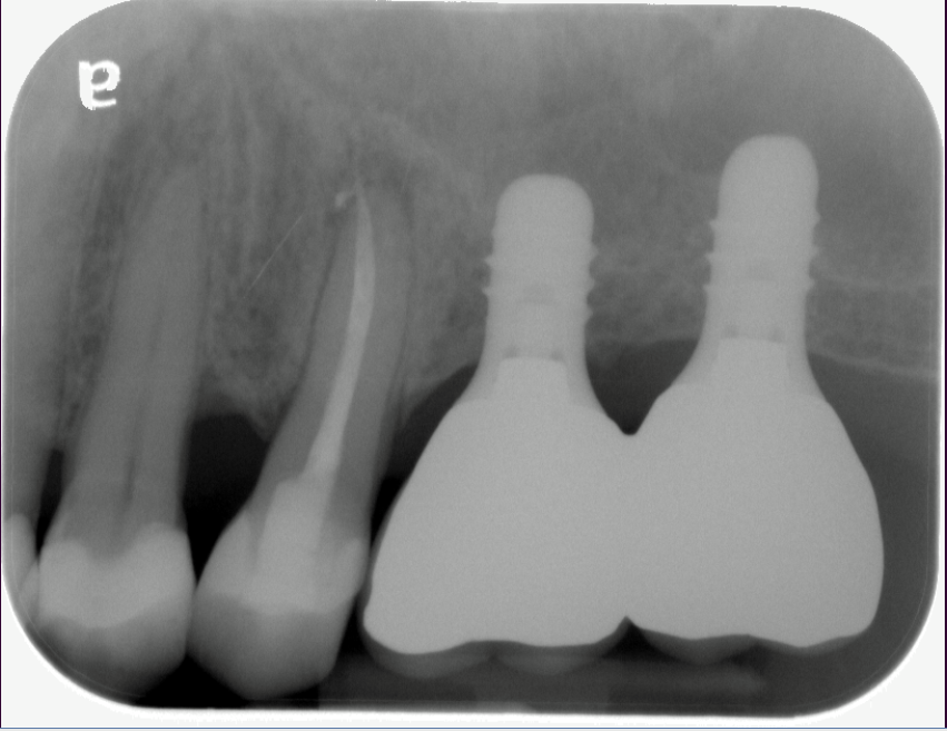 Sinus Lift implant Burnaby Periodontist IMPrESS Perio Implant