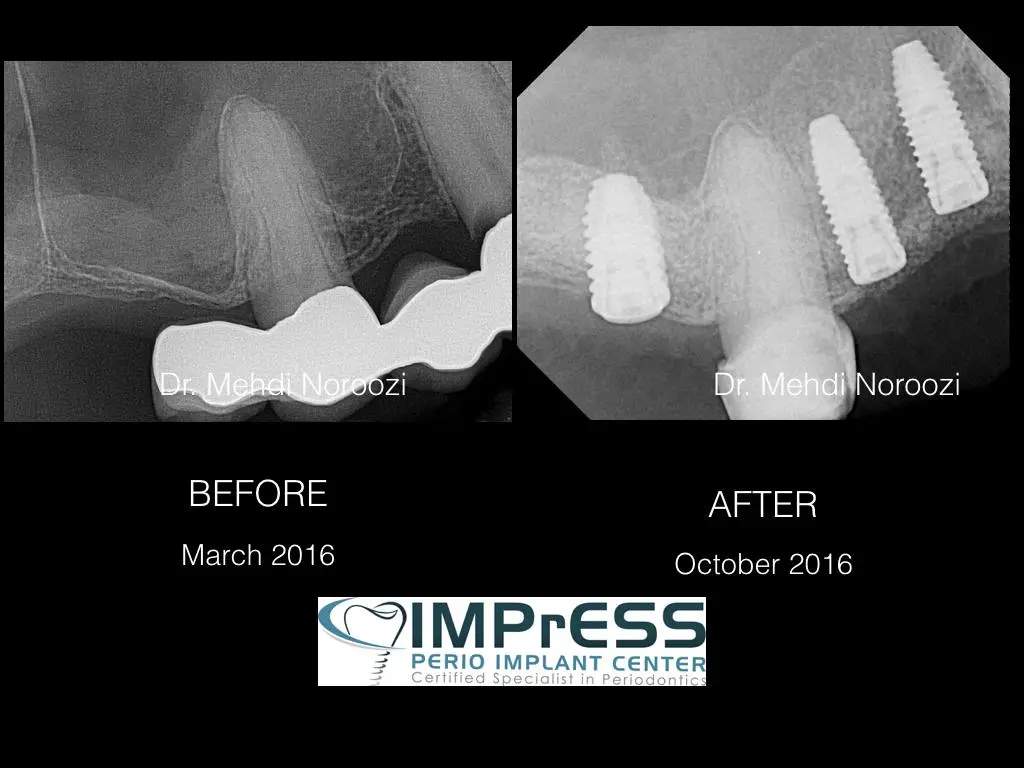 Dr. Noroozi Sinus Lift Surgery For Dental Implants IMPrESS Perio Implant Center