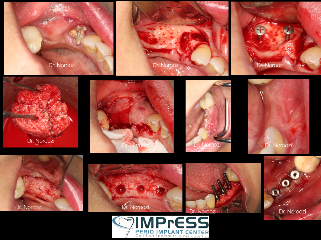 Bone Grafting for Dental Implant in Vancouver BC Periodontist Dr. Noroozi IMPrESS Perio Implant Center
