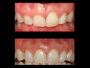 Gummy Smile Treatment in Vancouver Burnaby Periodontist IMPrESS