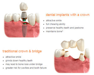 Dental Implants in Burnaby BC Vancouver BC implant dentist