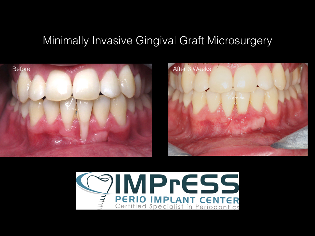 Best Gum Graft in Vancouver BC Vancouver Best Periodontist Gum Specialist IMPrESS Perio Implant Center
