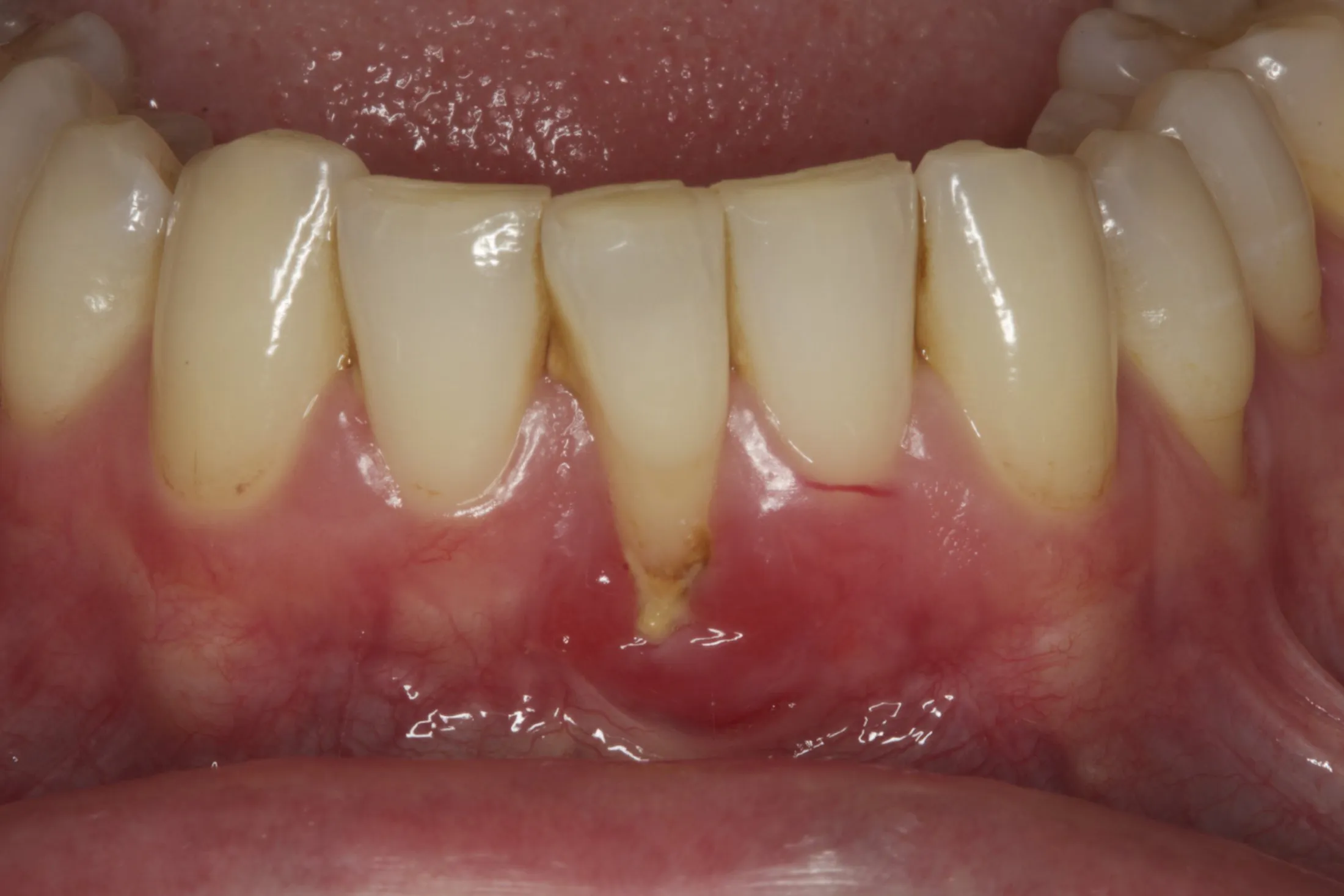 Gum graft burnaby periodontist IMPrESS Perio