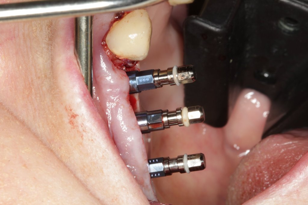 Burnaby Periodontist Bunraby Sinus lift IMPrESS Perio Implant Dr. Noroozi