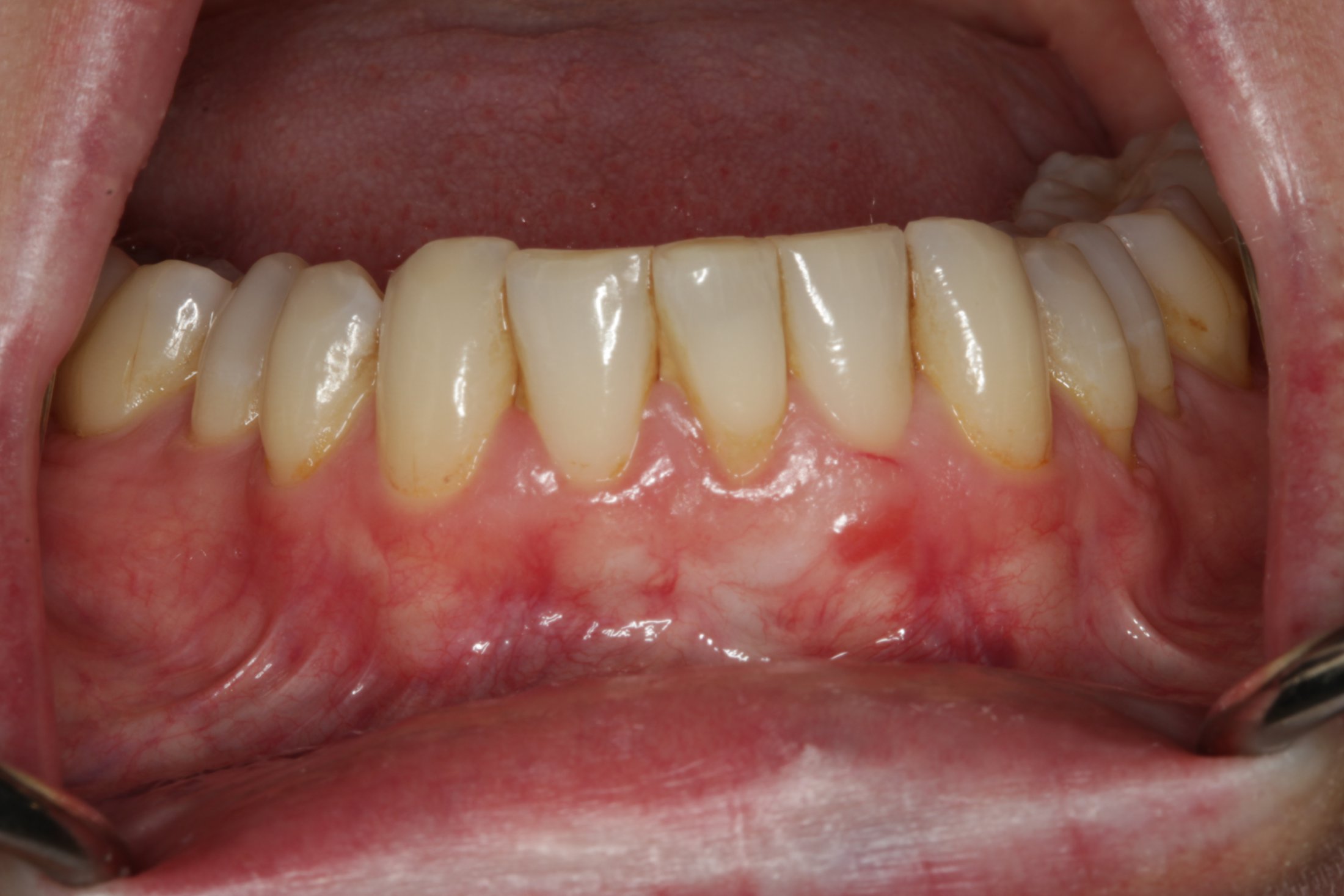 Gum graft burnaby periodontist IMPrESS Perio
