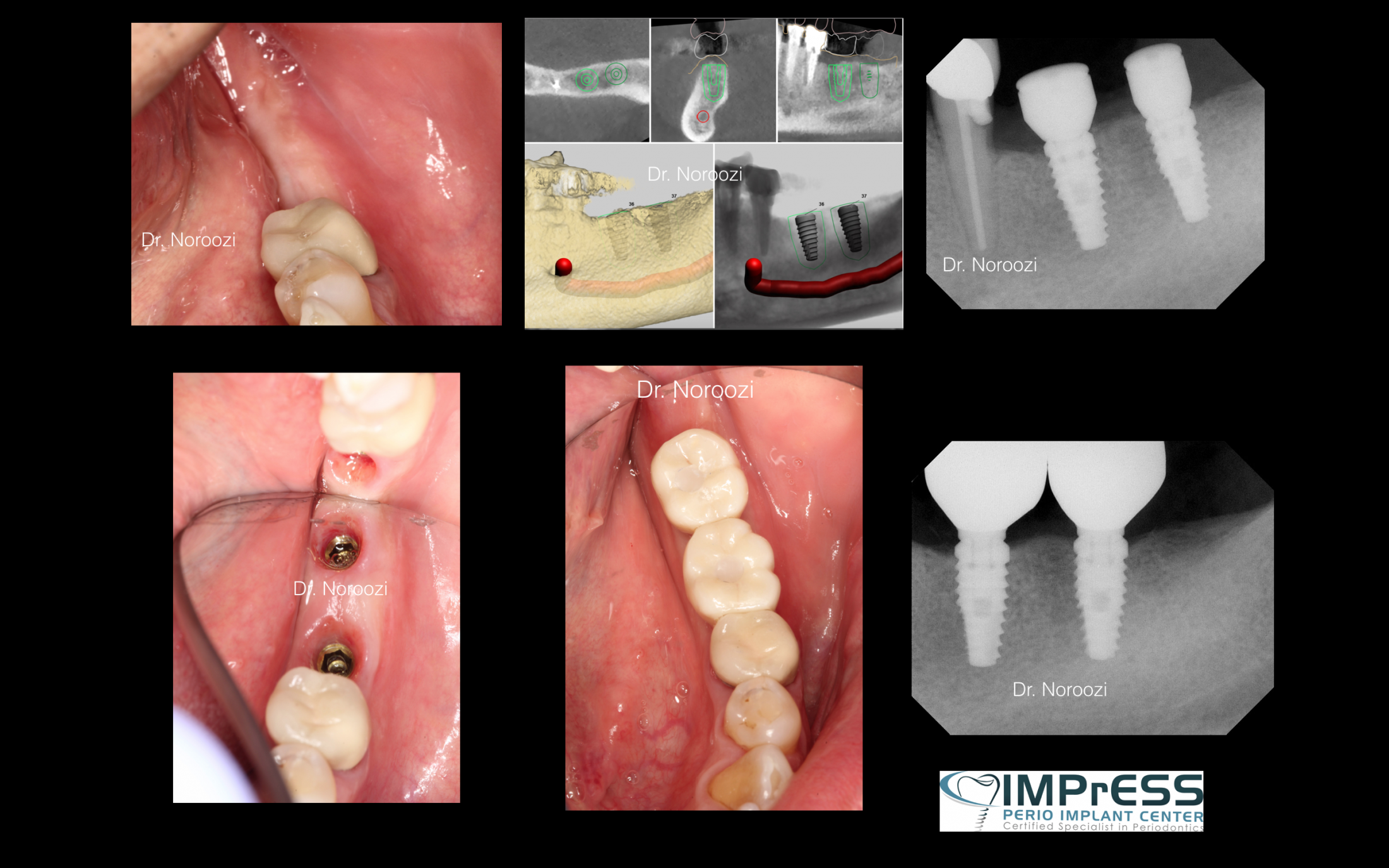 Vancouver BC Dental Implants IMPrESS Perio Implant Center