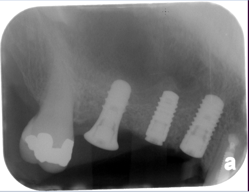 Osteotome Sinus Lift Burnaby Periodontist Bunraby Sinus lift IMPrESS Perio Implant Dr. Noroozi