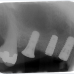 Osteotome Sinus Lift Burnaby Periodontist Bunraby Sinus lift IMPrESS Perio Implant Dr. Noroozi