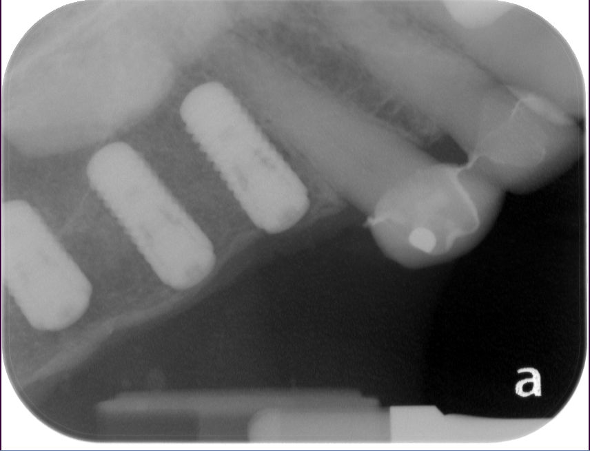 Burnaby Periodontist Bunraby Sinus lift IMPrESS Perio Implant Dr. Noroozi