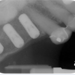 Burnaby Periodontist Bunraby Sinus lift IMPrESS Perio Implant Dr. Noroozi