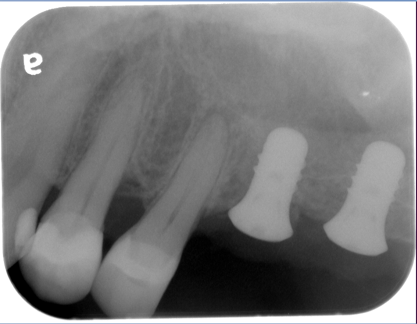 Burnaby Periodontist Sinus lift dental implants implant dentist