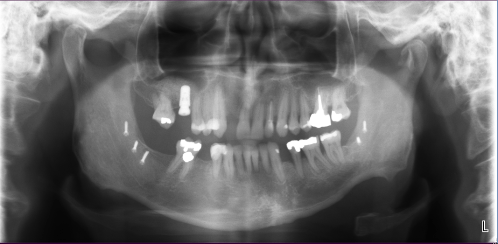 Burnaby Periodontist Bunraby Sinus lift IMPrESS Perio Implant Dr. Noroozi