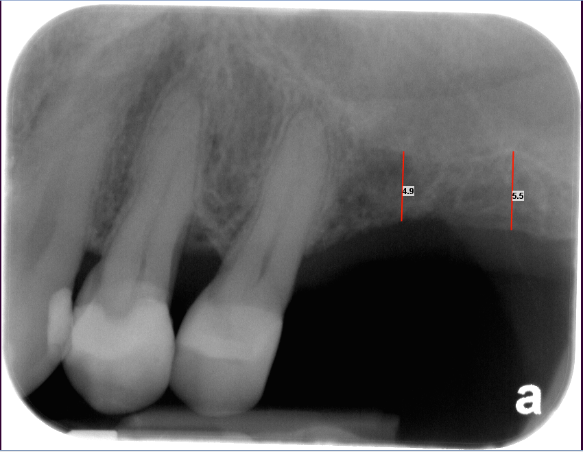 Burnaby Periodontist Sinus lift dental implants implant dentist