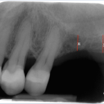Burnaby Periodontist Sinus lift dental implants implant dentist