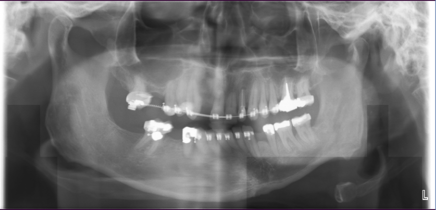 Burnaby Periodontist Bunraby Sinus lift IMPrESS Perio Implant Dr. Noroozi