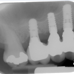 Osteotome Sinus Lift Burnaby Periodontist Bunraby Sinus lift IMPrESS Perio Implant Dr. Noroozi